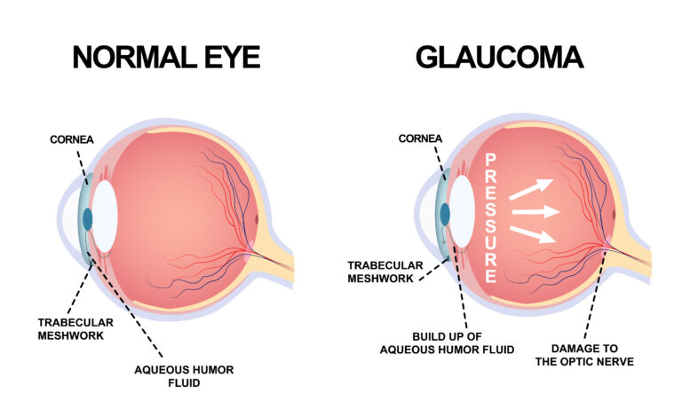 narang eye institute