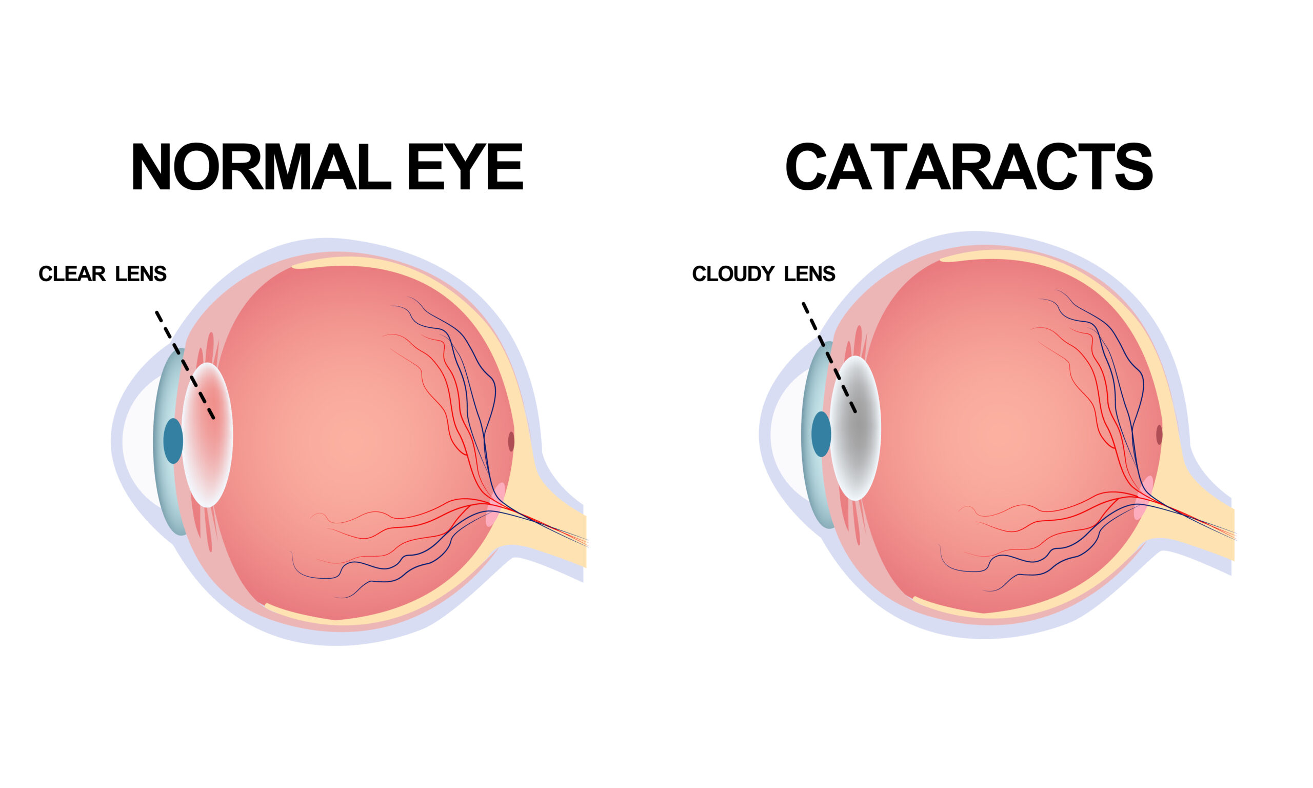 narang eye institute